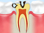 C2 象牙質の 虫歯