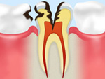 C3 神経に達した 虫歯