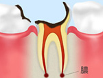 C4 末期の 虫歯